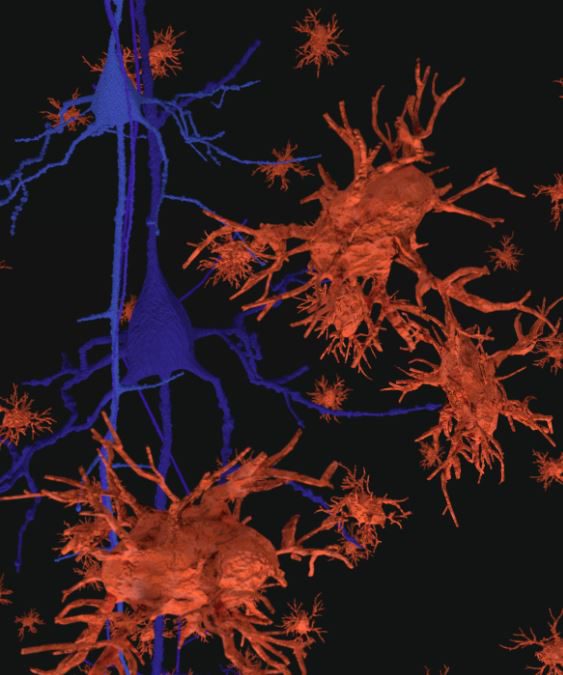 “Barcelona lab finds treatment that slows down Alzheimer’s”